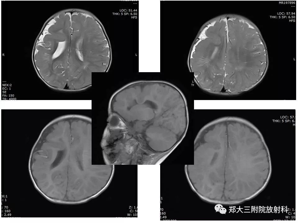 【病例】脑裂畸形3例MR影像解读