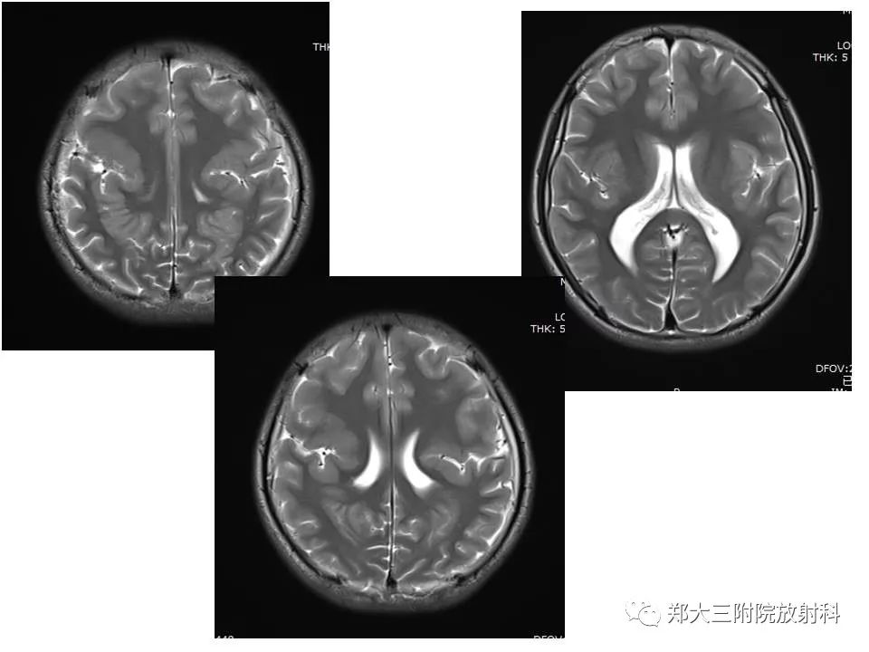 【病例】脑裂畸形3例MR影像解读