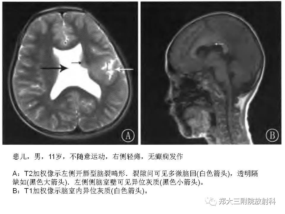 【病例】脑裂畸形3例MR影像解读