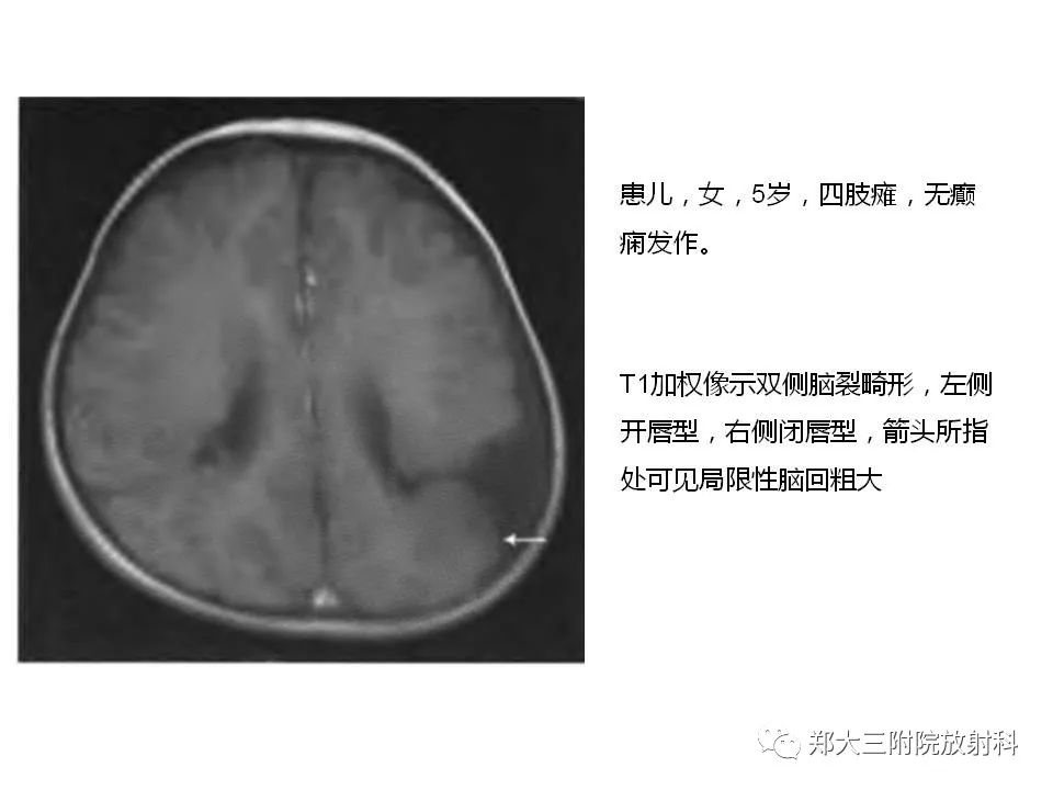 【病例】脑裂畸形3例MR影像解读