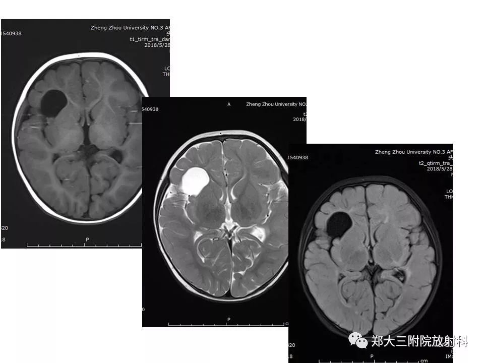 【病例】脑裂畸形3例MR影像解读