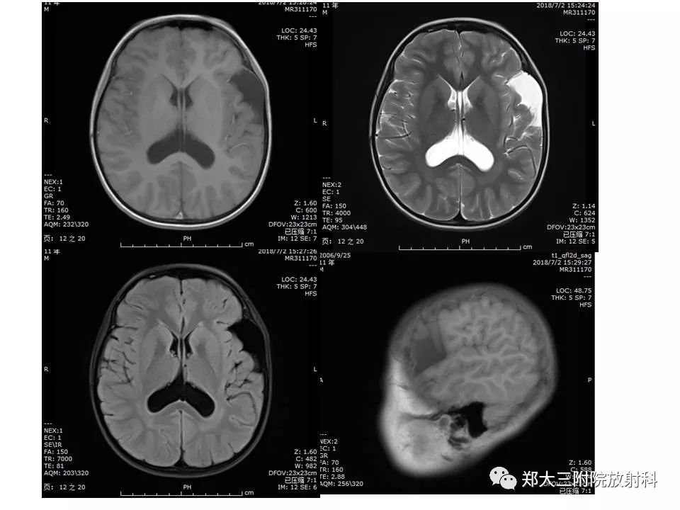 【病例】脑裂畸形3例MR影像解读