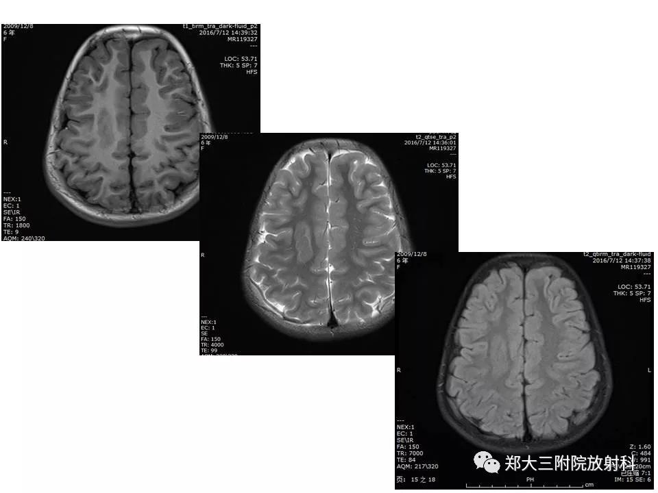 【病例】脑裂畸形3例MR影像解读