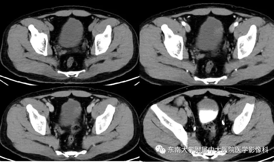【病例】腺性膀胱炎1例CT影像