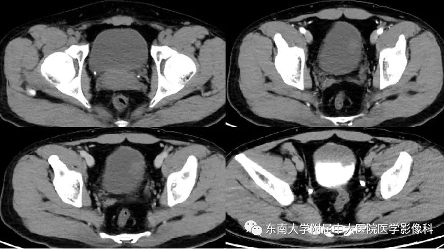 【病例】腺性膀胱炎1例CT影像