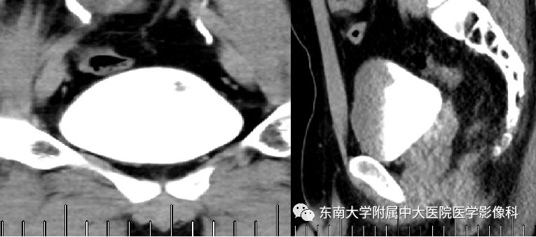 【病例】腺性膀胱炎1例CT影像