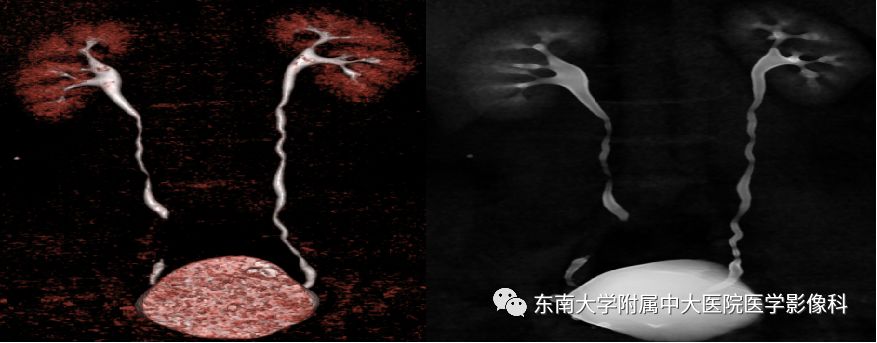 【病例】腺性膀胱炎1例CT影像