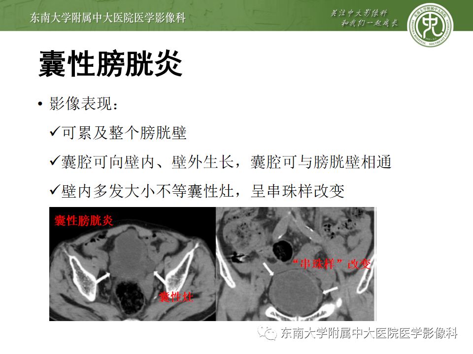 【病例】腺性膀胱炎1例CT影像