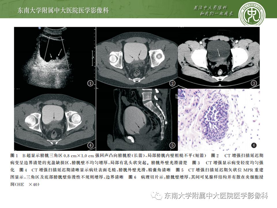 【病例】腺性膀胱炎1例CT影像