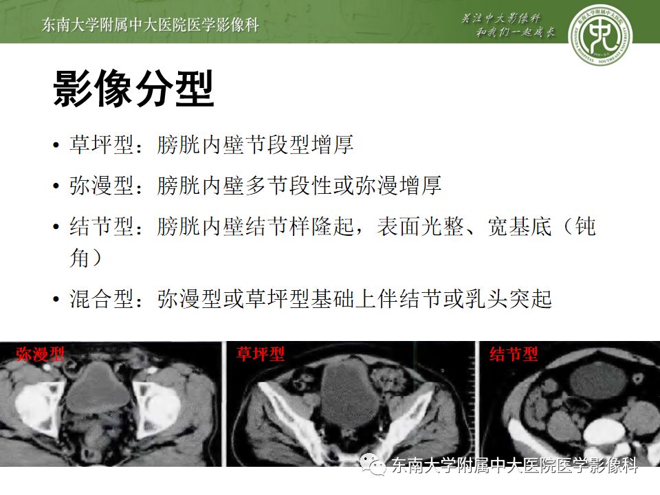 【病例】腺性膀胱炎1例CT影像