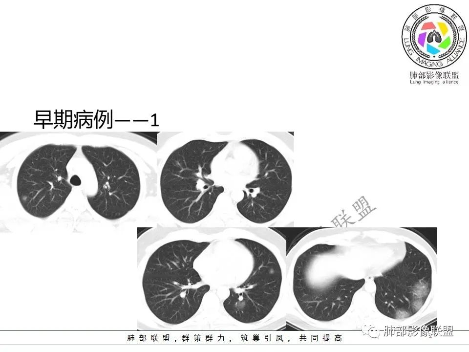 【PPT】关于180余例新冠肺炎(NCP)的影像分析与思考 【PPT】关于180余例新冠肺炎(NCP)的影像分析与思考