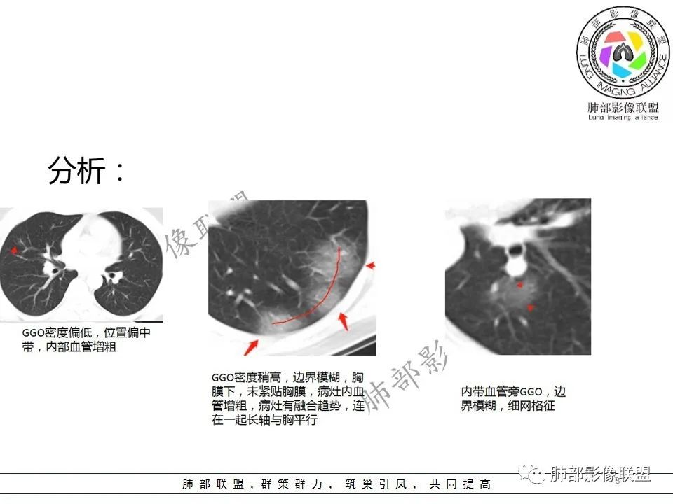 【PPT】关于180余例新冠肺炎(NCP)的影像分析与思考 【PPT】关于180余例新冠肺炎(NCP)的影像分析与思考