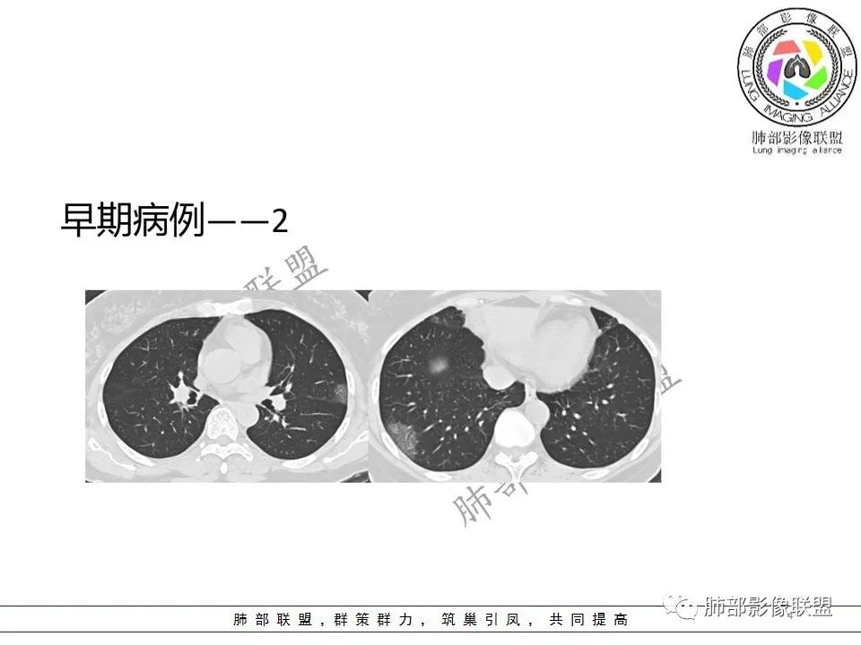 【PPT】关于180余例新冠肺炎(NCP)的影像分析与思考 【PPT】关于180余例新冠肺炎(NCP)的影像分析与思考