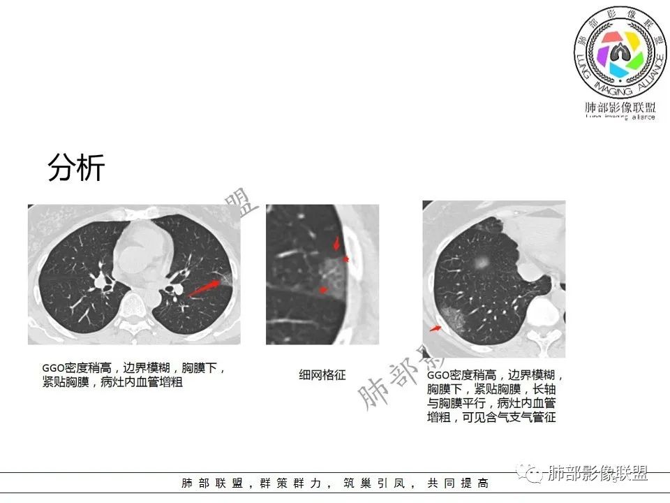 【PPT】关于180余例新冠肺炎(NCP)的影像分析与思考 【PPT】关于180余例新冠肺炎(NCP)的影像分析与思考