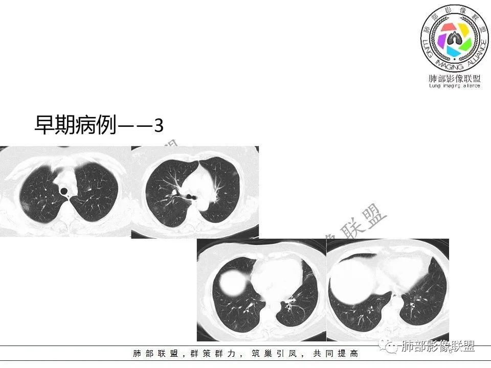 【PPT】关于180余例新冠肺炎(NCP)的影像分析与思考 【PPT】关于180余例新冠肺炎(NCP)的影像分析与思考