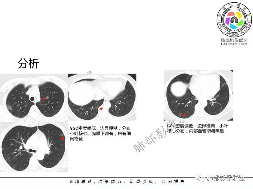 【PPT】关于180余例新冠肺炎(NCP)的影像分析与思考 【PPT】关于180余例新冠肺炎(NCP)的影像分析与思考