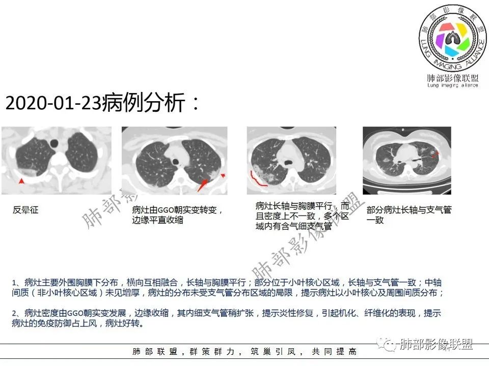 【PPT】关于180余例新冠肺炎(NCP)的影像分析与思考 【PPT】关于180余例新冠肺炎(NCP)的影像分析与思考