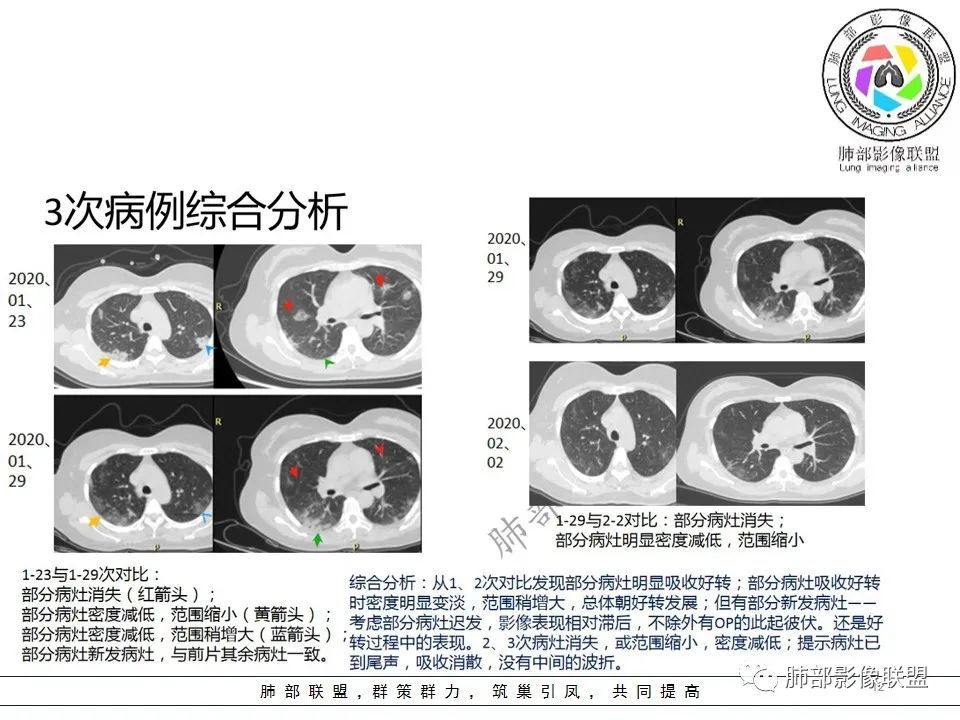 【PPT】关于180余例新冠肺炎(NCP)的影像分析与思考 【PPT】关于180余例新冠肺炎(NCP)的影像分析与思考