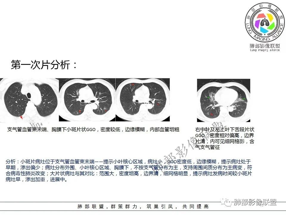 【PPT】关于180余例新冠肺炎(NCP)的影像分析与思考 【PPT】关于180余例新冠肺炎(NCP)的影像分析与思考
