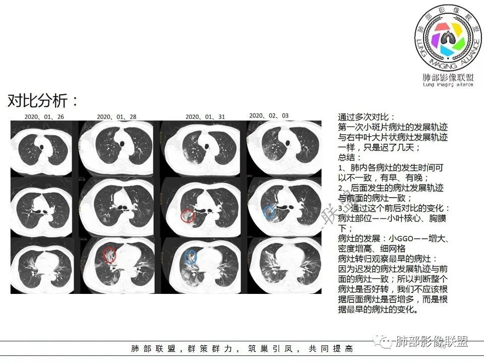 【PPT】关于180余例新冠肺炎(NCP)的影像分析与思考 【PPT】关于180余例新冠肺炎(NCP)的影像分析与思考