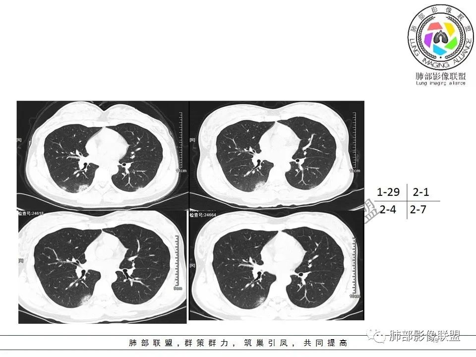 【PPT】关于180余例新冠肺炎(NCP)的影像分析与思考 【PPT】关于180余例新冠肺炎(NCP)的影像分析与思考