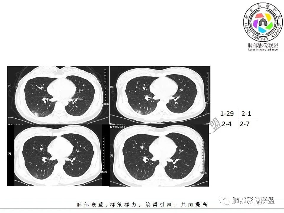 【PPT】关于180余例新冠肺炎(NCP)的影像分析与思考 【PPT】关于180余例新冠肺炎(NCP)的影像分析与思考