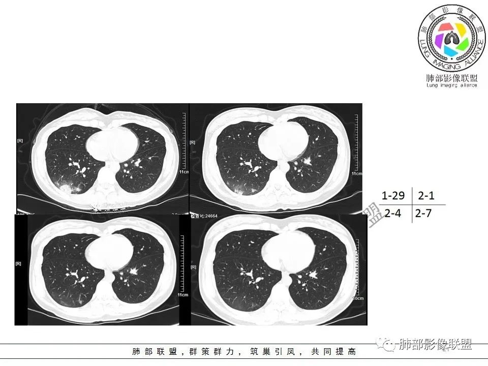 【PPT】关于180余例新冠肺炎(NCP)的影像分析与思考 【PPT】关于180余例新冠肺炎(NCP)的影像分析与思考