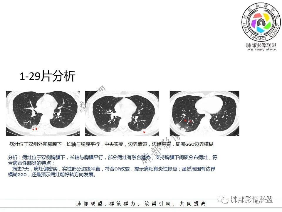 【PPT】关于180余例新冠肺炎(NCP)的影像分析与思考 【PPT】关于180余例新冠肺炎(NCP)的影像分析与思考