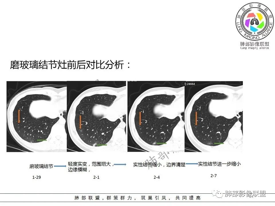 【PPT】关于180余例新冠肺炎(NCP)的影像分析与思考 【PPT】关于180余例新冠肺炎(NCP)的影像分析与思考