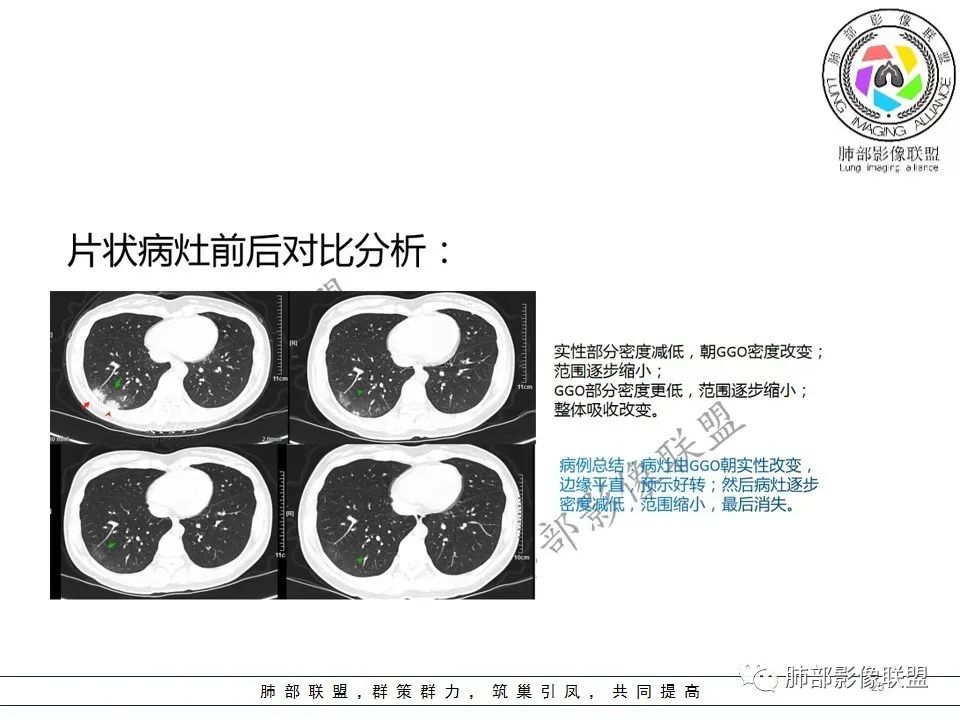 【PPT】关于180余例新冠肺炎(NCP)的影像分析与思考 【PPT】关于180余例新冠肺炎(NCP)的影像分析与思考
