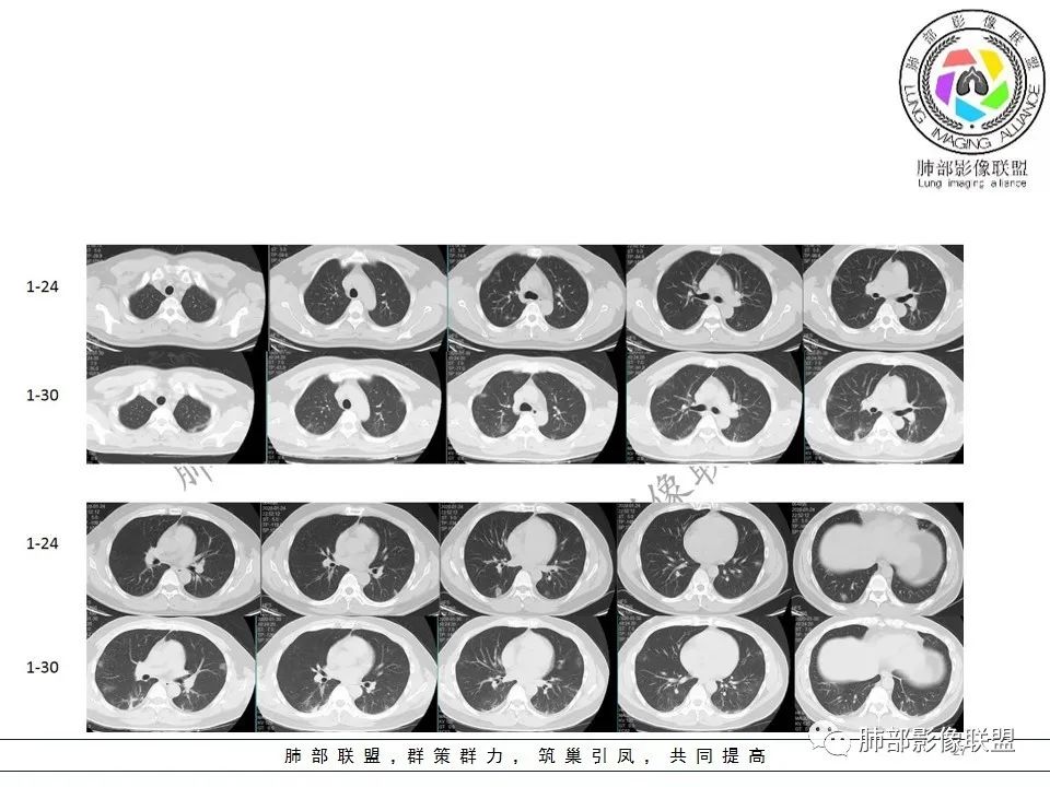 【PPT】关于180余例新冠肺炎(NCP)的影像分析与思考 【PPT】关于180余例新冠肺炎(NCP)的影像分析与思考