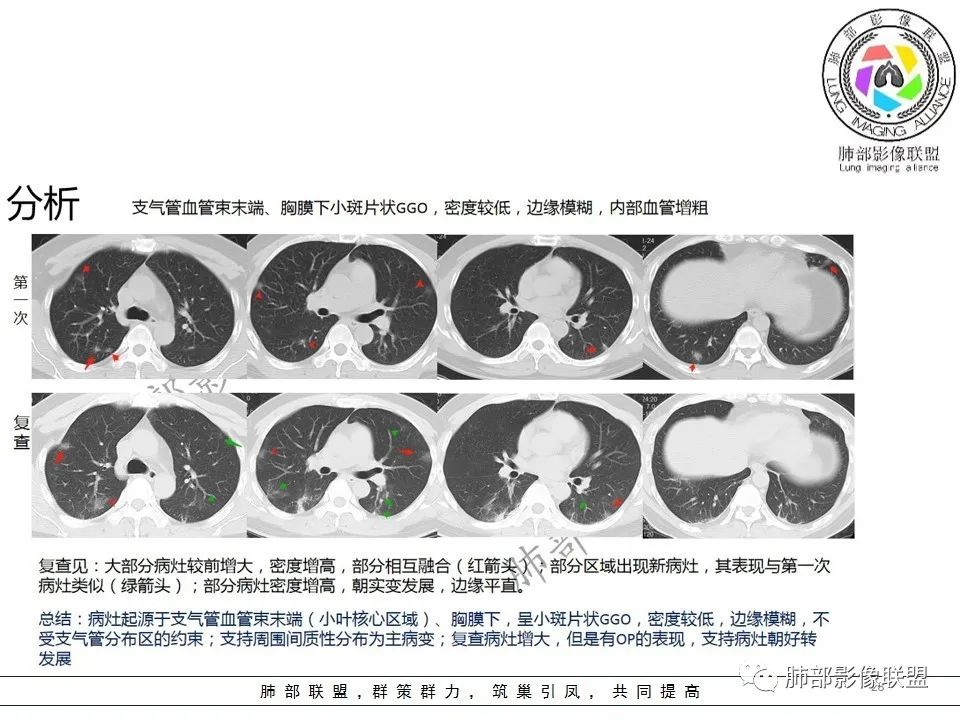 【PPT】关于180余例新冠肺炎(NCP)的影像分析与思考 【PPT】关于180余例新冠肺炎(NCP)的影像分析与思考