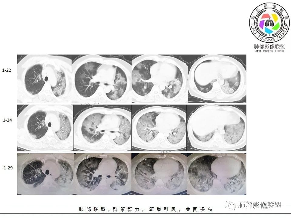【PPT】关于180余例新冠肺炎(NCP)的影像分析与思考 【PPT】关于180余例新冠肺炎(NCP)的影像分析与思考