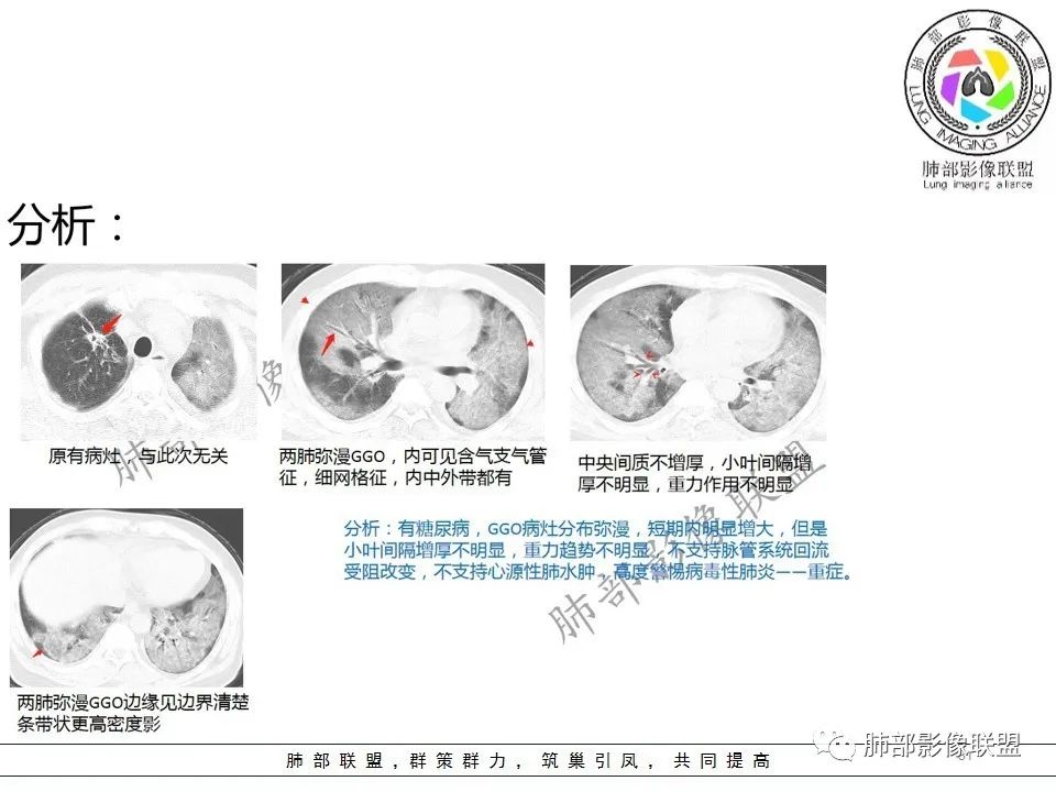 【PPT】关于180余例新冠肺炎(NCP)的影像分析与思考 【PPT】关于180余例新冠肺炎(NCP)的影像分析与思考