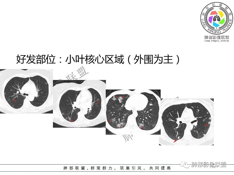 【PPT】关于180余例新冠肺炎(NCP)的影像分析与思考 【PPT】关于180余例新冠肺炎(NCP)的影像分析与思考