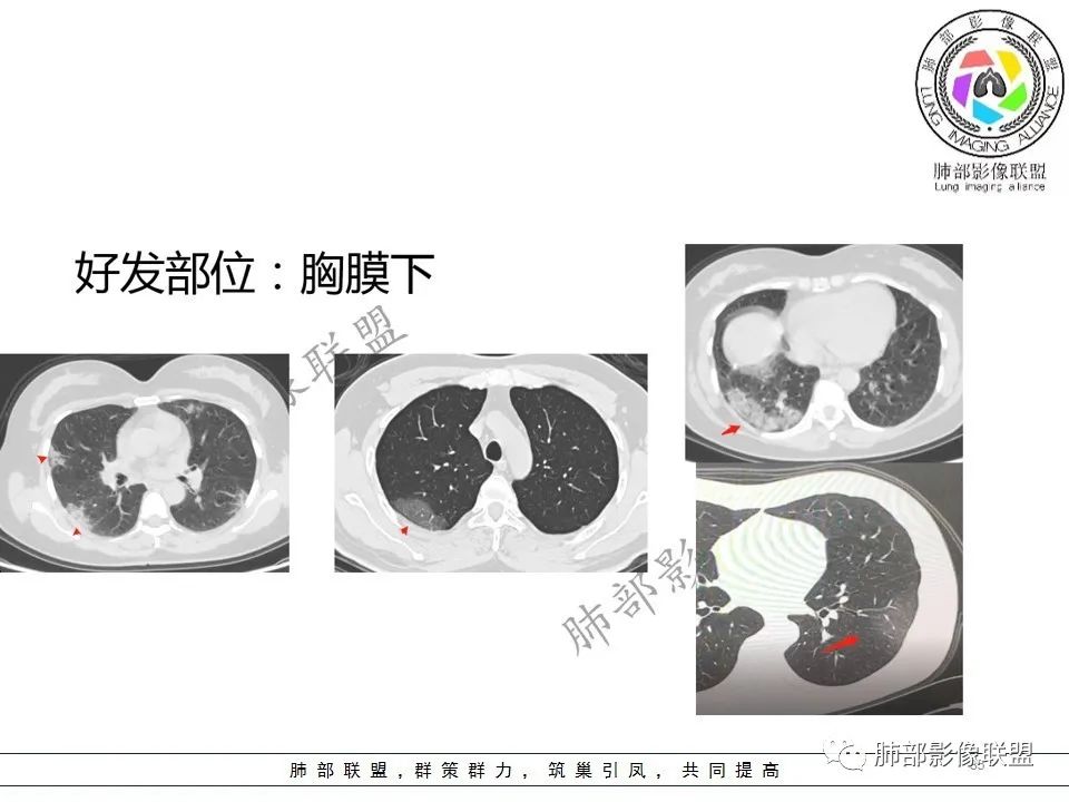 【PPT】关于180余例新冠肺炎(NCP)的影像分析与思考 【PPT】关于180余例新冠肺炎(NCP)的影像分析与思考