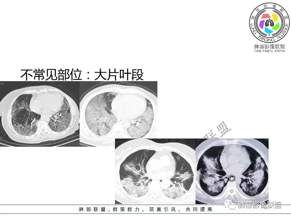 【PPT】关于180余例新冠肺炎(NCP)的影像分析与思考 【PPT】关于180余例新冠肺炎(NCP)的影像分析与思考