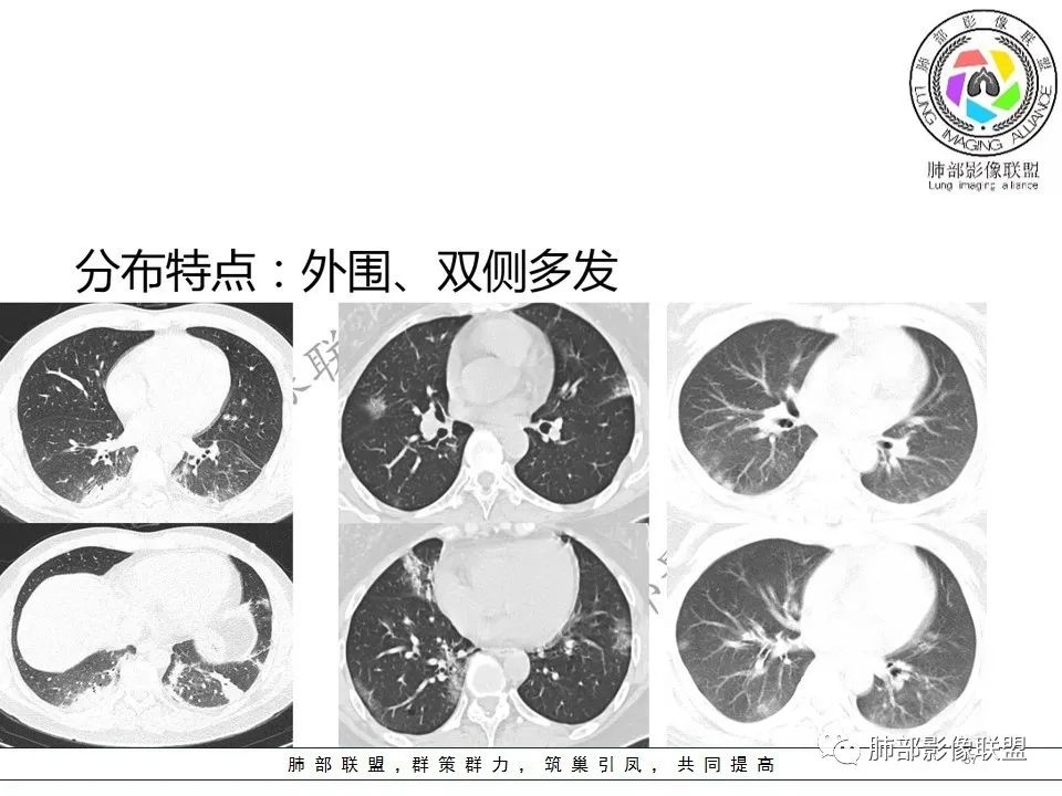 【PPT】关于180余例新冠肺炎(NCP)的影像分析与思考 【PPT】关于180余例新冠肺炎(NCP)的影像分析与思考