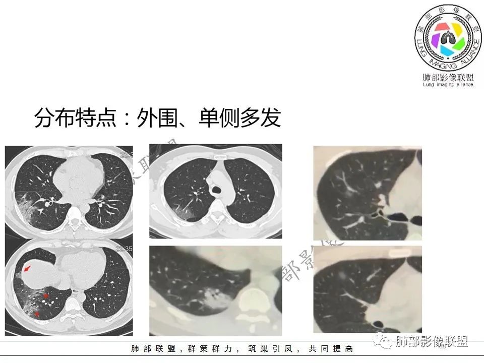 【PPT】关于180余例新冠肺炎(NCP)的影像分析与思考 【PPT】关于180余例新冠肺炎(NCP)的影像分析与思考