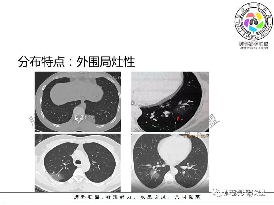 【PPT】关于180余例新冠肺炎(NCP)的影像分析与思考 【PPT】关于180余例新冠肺炎(NCP)的影像分析与思考
