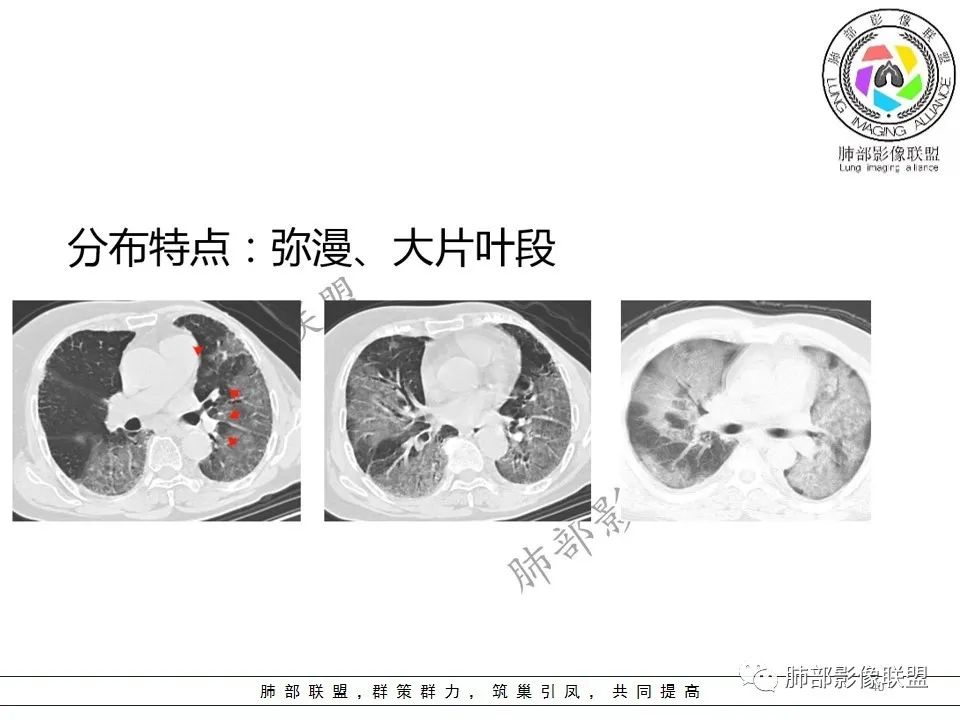 【PPT】关于180余例新冠肺炎(NCP)的影像分析与思考 【PPT】关于180余例新冠肺炎(NCP)的影像分析与思考