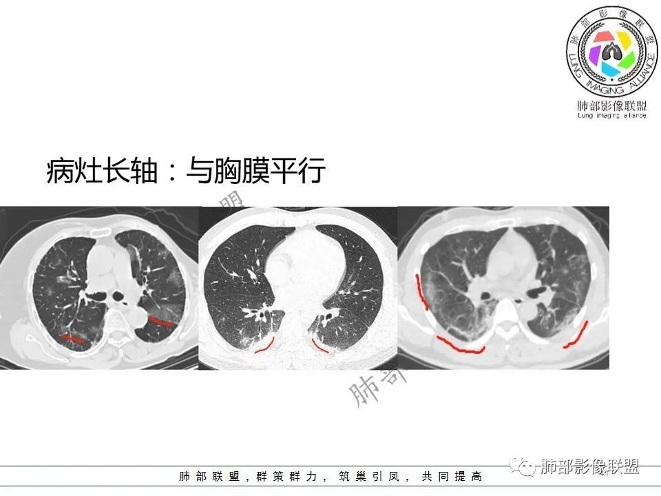 【PPT】关于180余例新冠肺炎(NCP)的影像分析与思考 【PPT】关于180余例新冠肺炎(NCP)的影像分析与思考