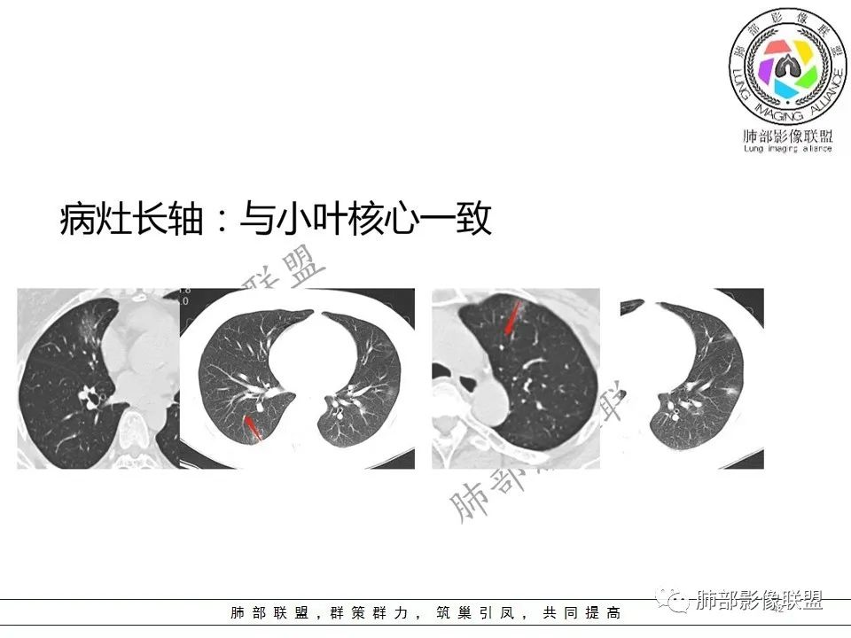 【PPT】关于180余例新冠肺炎(NCP)的影像分析与思考 【PPT】关于180余例新冠肺炎(NCP)的影像分析与思考