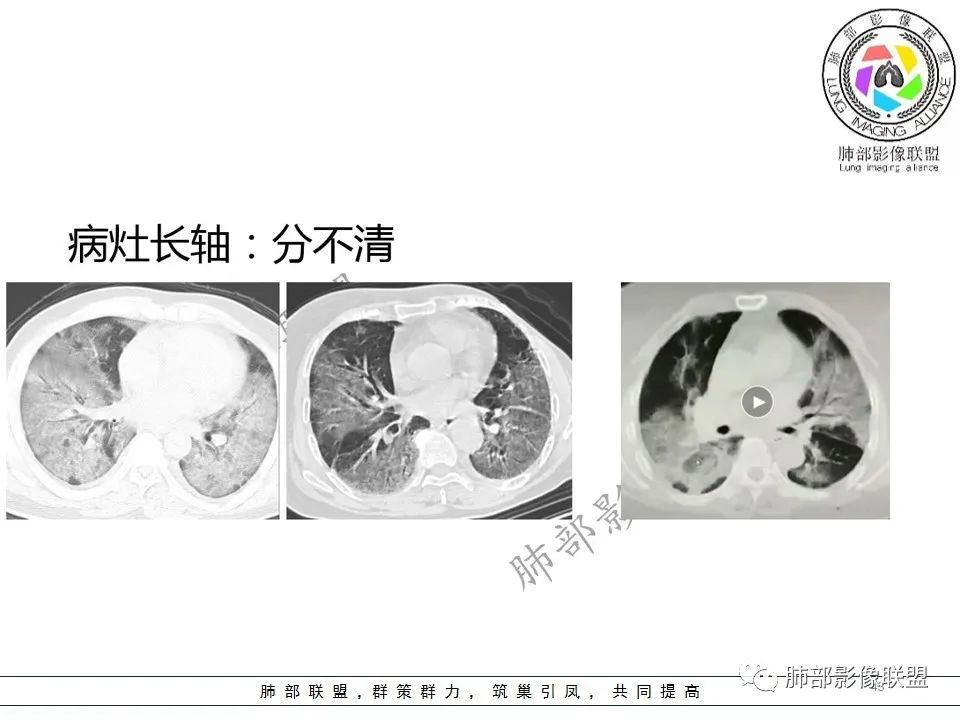 【PPT】关于180余例新冠肺炎(NCP)的影像分析与思考 【PPT】关于180余例新冠肺炎(NCP)的影像分析与思考