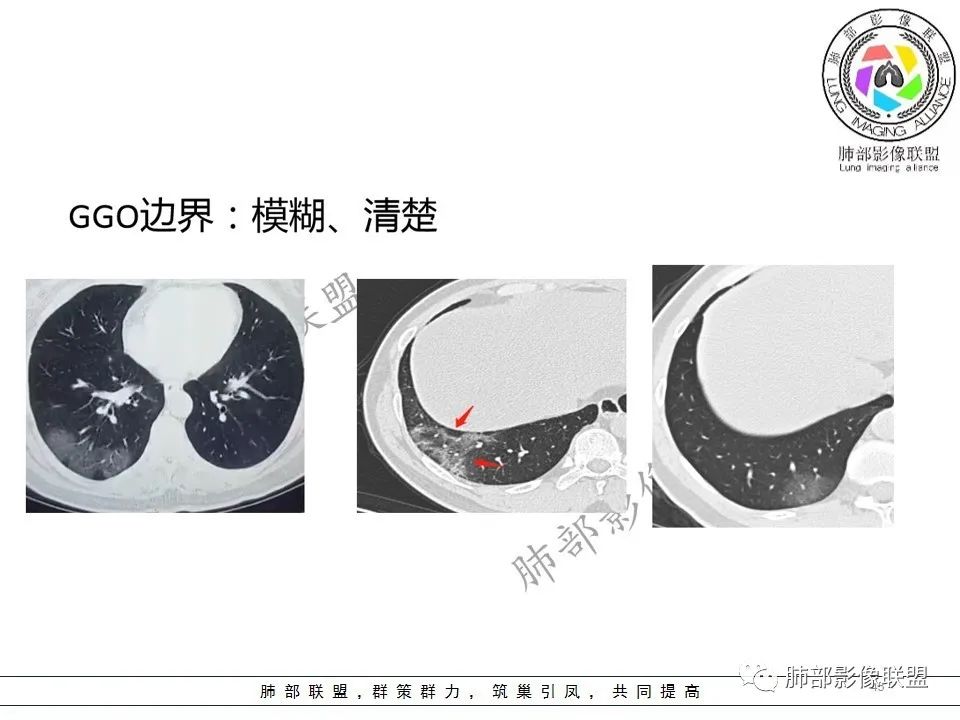 【PPT】关于180余例新冠肺炎(NCP)的影像分析与思考 【PPT】关于180余例新冠肺炎(NCP)的影像分析与思考