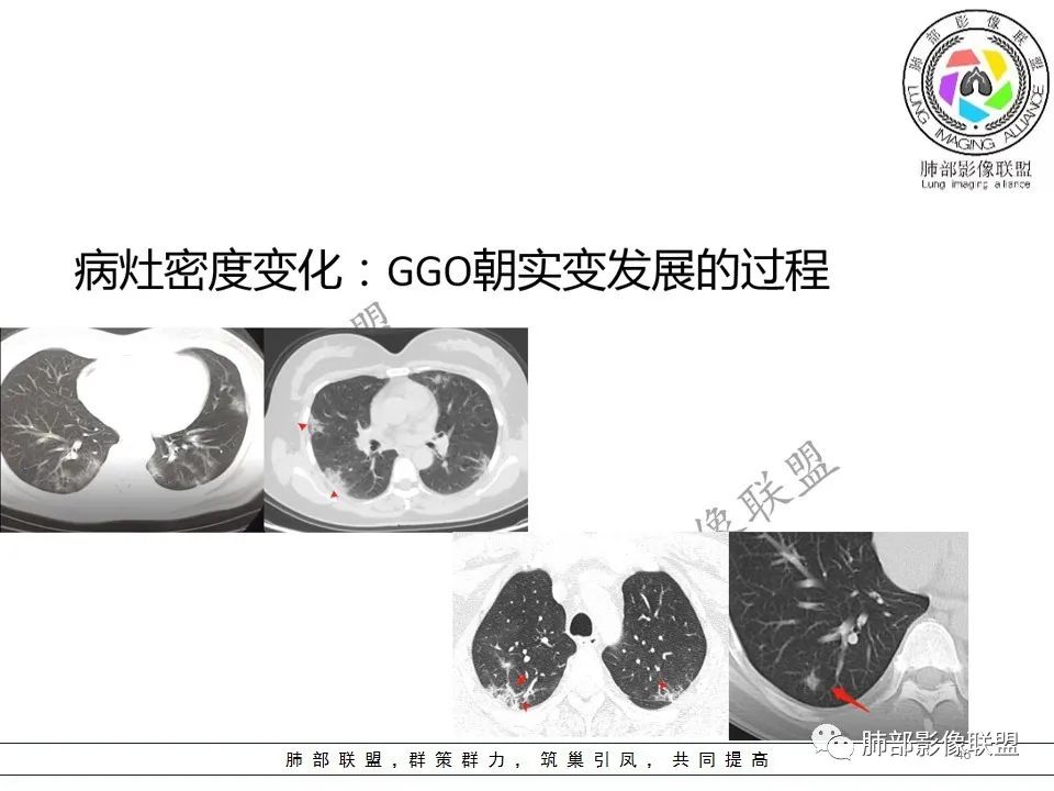 【PPT】关于180余例新冠肺炎(NCP)的影像分析与思考 【PPT】关于180余例新冠肺炎(NCP)的影像分析与思考