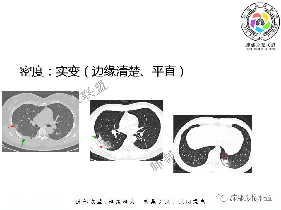 【PPT】关于180余例新冠肺炎(NCP)的影像分析与思考 【PPT】关于180余例新冠肺炎(NCP)的影像分析与思考
