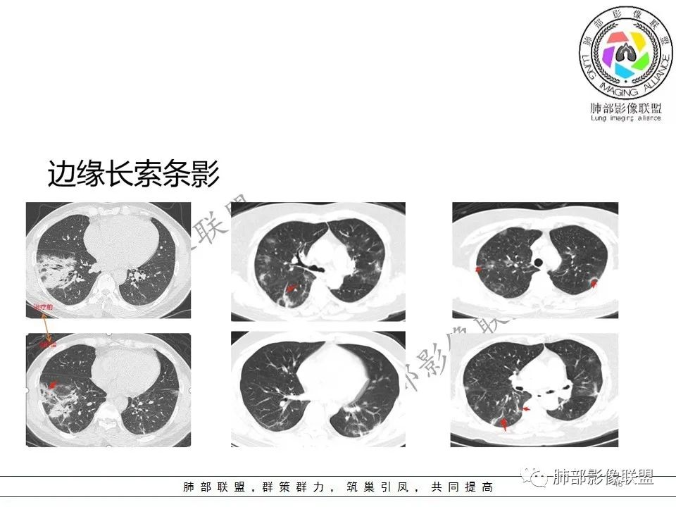 【PPT】关于180余例新冠肺炎(NCP)的影像分析与思考 【PPT】关于180余例新冠肺炎(NCP)的影像分析与思考