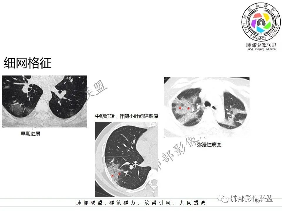 【PPT】关于180余例新冠肺炎(NCP)的影像分析与思考 【PPT】关于180余例新冠肺炎(NCP)的影像分析与思考