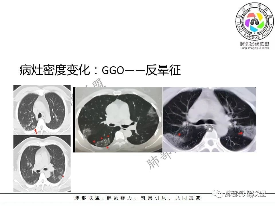 【PPT】关于180余例新冠肺炎(NCP)的影像分析与思考 【PPT】关于180余例新冠肺炎(NCP)的影像分析与思考